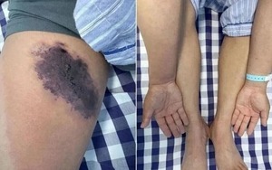 Mặc chiếc quần cũ, người đàn ông suýt "nhiễm độc toàn thân"