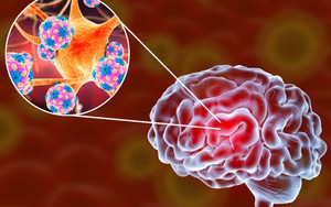 Người phụ nữ viêm màng não nguy kịch tính mạng: Bác sĩ nói thẳng thủ phạm đến từ môi trường sống