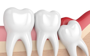 Nhổ răng khôn có được BHYT chi trả?