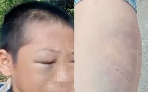 Xôn xao clip bé trai mắt bầm tím, khóc kêu cứu vì nhiều lần bị đánh đập khi ở cùng bố và vợ mới
