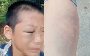 Bé trai 11 tuổi nghi bị bố và mẹ kế bạo hành ở Nghệ An: Công an vào cuộc
