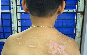 Bắt giam người bố đánh con trai 7 tuổi thương tích 36% khi kèm học
