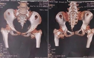 Bé gái 12 tuổi mắc "hội chứng người hóa đá hiếm gặp", bố mẹ ngỡ ngàng khi bác sĩ nhắc tới cú ngã xe đạp 2 năm trước
