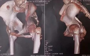 Phát hiện hội chứng "người hóa đá" thể hiếm ở một bé gái 12 tuổi