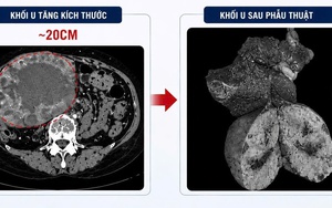 Khối u gan “lớn nhanh như thổi”, tăng kích thước 10 lần sau khi uống loại nước này thường xuyên