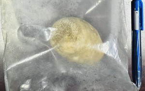 Món quà "độc nhất vô nhị" của bệnh nhân sau ca mổ: Lời cảnh báo về 1 kiểu uống nước của nhiều người Việt