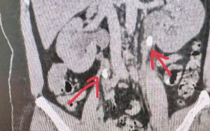 Bác sĩ giật mình khi xem hình ảnh CT thận của bệnh nhân