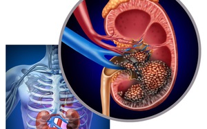 Người đàn ông bất ngờ phát hiện ung thư thận khi đi khám sức khỏe định kỳ: Tôi mới 32 tuổi, sao có thể...