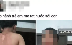Công an vào cuộc vụ bé trai ở Đắk Lắk nghi bị mẹ tạt nước sôi