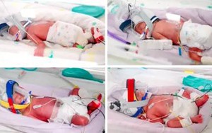 Người phụ nữ sinh 4 bé gái giống hệt nhau cùng trứng, cùng chung một bánh nhau; bác sĩ nói: "Gần như chưa từng có"