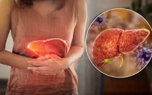 Gan đang “kêu cứu” nhưng nhiều người không biết: Bác sĩ chỉ ra 5 dấu hiệu cảnh báo sớm