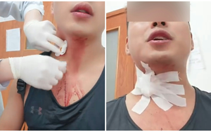 Khó tin: Nhập viện do vỡ tĩnh mạch sau khi cố đập... muỗi