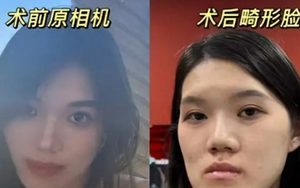 Nữ người mẫu 24 tuổi phẫu thuật thẩm mỹ từ bị móm nhẹ thành mặt lưỡi cày: Lời giải thích của bác sĩ gây phẫn nộ