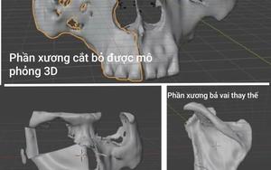 Chỉ trong 3 tháng, người đàn ông Hà Nội bị “ăn mòn” một phần mặt: Nguyên nhân do đâu?