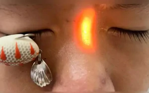 Lưỡi câu ghim thẳng vào mắt bé trai 13 tuổi gây mù
