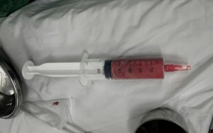 Bệnh viện Trung ương Quân đội 108 cảnh báo những người tiêm filler 5-10 năm trước