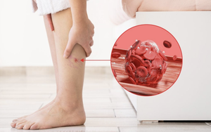 Bất kể giới tính, nếu điều này xuất hiện trên chân, đó có thể là dấu hiệu của cục máu đông trong cơ thể