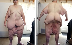 Chụp ảnh nude với mong muốn được cắt bỏ 38kg da thừa