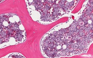 Ghép tủy xương trị HIV