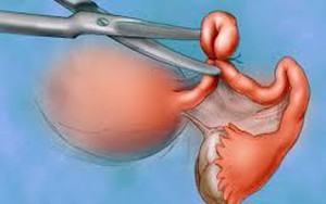 Chồng triệt sản, vợ vẫn sòn sòn dính bầu