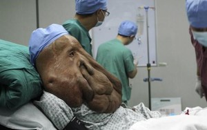 Người mặt voi Trung Quốc trải qua ca phẫu thuật lần ba