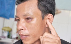 Một công an viên làm dân thủng màng nhĩ, bầm hốc mắt