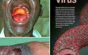 Người bệnh nhiễm virut Ebola tử vong đáng sợ thế nào?