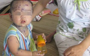 Hết vaccine thủy đậu, Bộ Y tế đổ lỗi tại dân