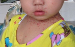 Bệnh tay chân miệng xuất hiện sớm hơn mọi năm