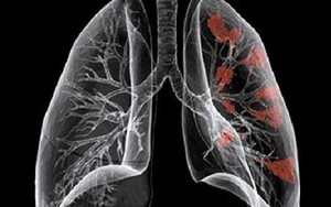 Những biểu hiện của bệnh ung thư phổi