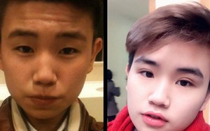 Teen boy Hà Nội công khai quá trình phẫu thuật thẩm mỹ gây sốc