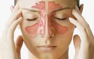 Bài thuốc chữa viêm xoang, viêm mũi dị ứng tận gốc không tái phát