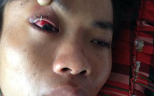 Công an xã bị tố đánh người dập lá lách