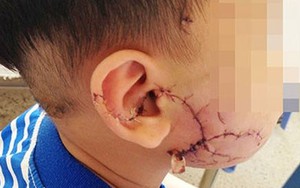 Những nguy hiểm không ngờ đến khi bị chó cắn