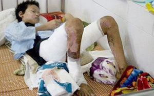 Vụ mẹ đẩy con vào đống lửa: Cháu bé 13 tuổi nguy kịch vì bị để trong nhà 4 ngày không đưa đi viện