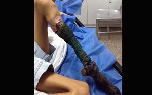 Kinh hoàng bàn chân bé gái biến dạng thành “gốc cây khô” sau khi bị rắn cắn