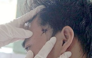 Trưởng công an xã bắn chim, đạn lạc trúng 2 người