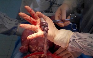 Hy hữu thai nhi có dây rốn thắt nút 2 vòng vẫn sống sót