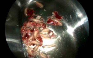 Lấy 50 con dòi khỏi mũi bệnh nhân