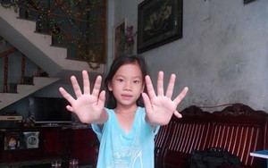 Cô bé có 24 ngón tay, chân ở Quảng Nam