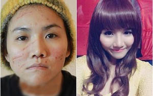 Chuyên gia Photoshop phân tích gương mặt đầy sẹo của Anh Thúy