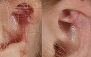 Chị chồng cắn rách vành tai của em dâu