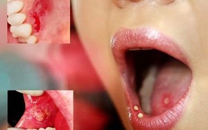 Biểu hiện không ngờ chứng tỏ bạn có nguy cơ bị ung thư miệng