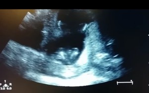 Thai nhi 4 tháng tuổi vỗ tay trong bụng mẹ