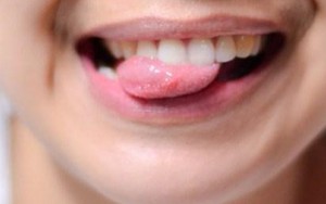 Đoán bệnh qua những biểu hiện ở lưỡi
