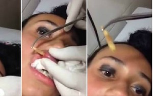 Hãi hùng: Tận mắt với cảnh gắp con giòi ra khỏi môi người phụ nữ