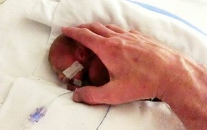 Hành trình sống sót diệu kỳ của em bé chỉ nặng 6 lạng