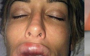 Cô gái sưng vều môi vì bị giòi ký sinh bên trong