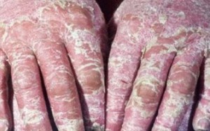 Căn bệnh "dị" khiến từng phần cơ thể bong tróc, đau đến phát khóc