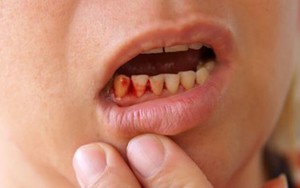 Sai lầm khi xỉa răng khiến bạn "rước họa" khôn lường